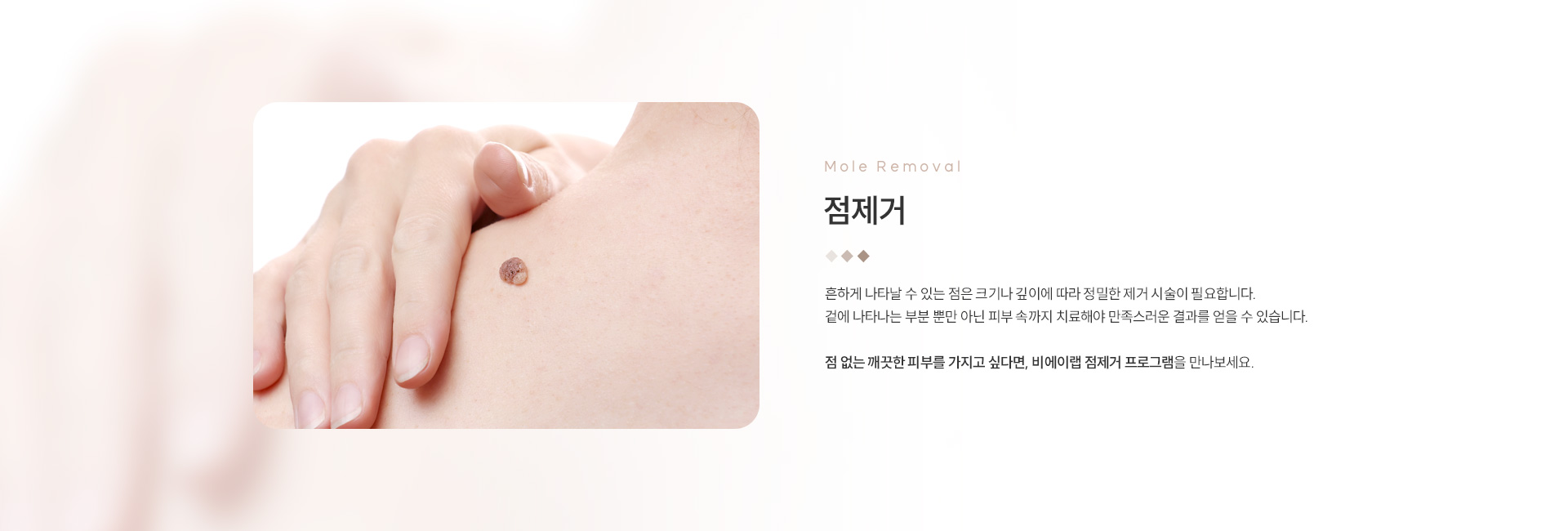 점/문신제거 01