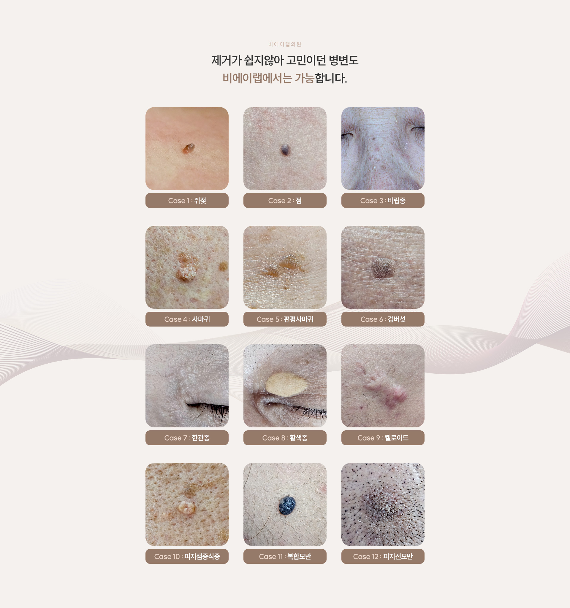 점/문신제거 03