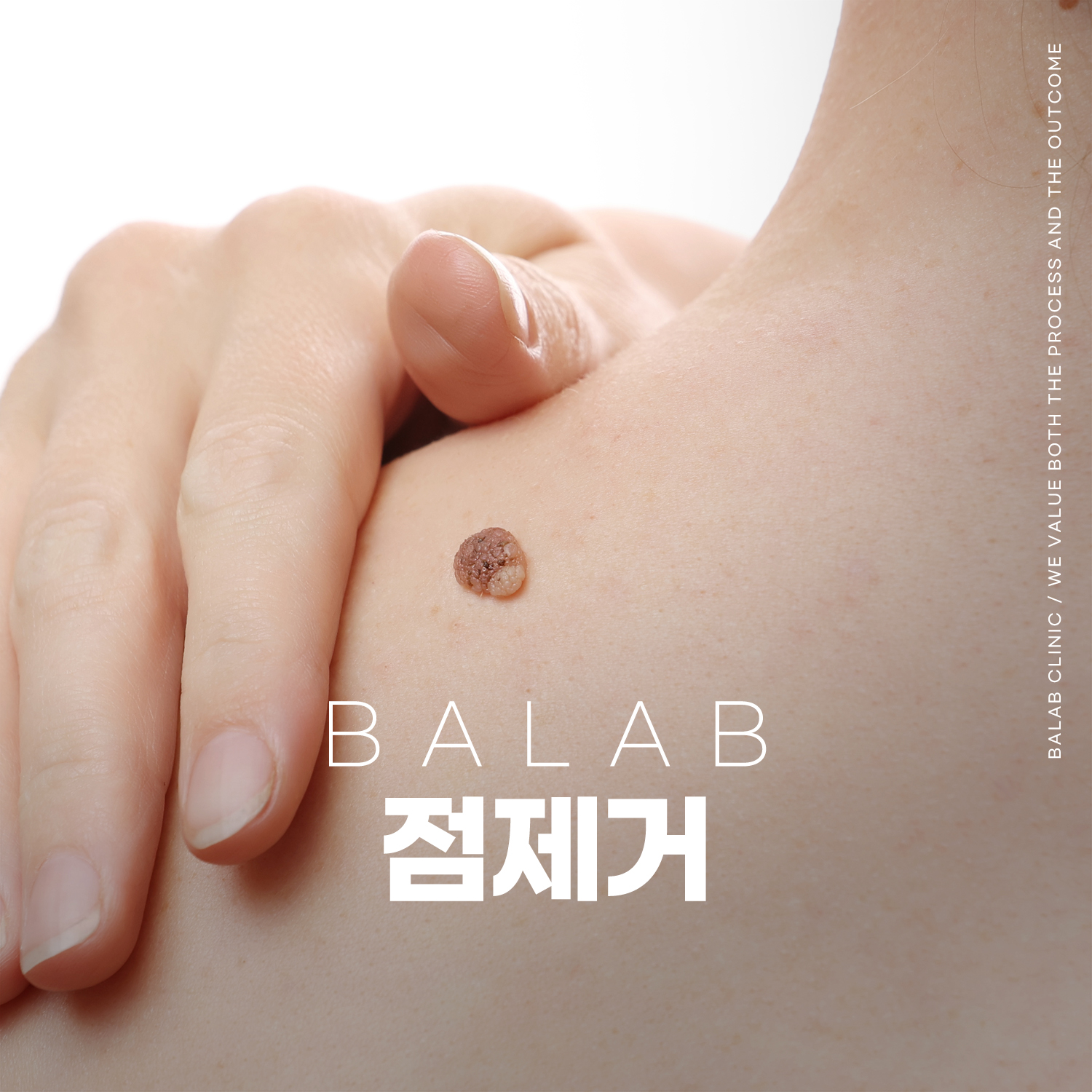 점제거